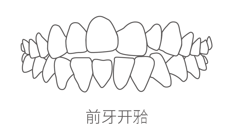 前牙开颌