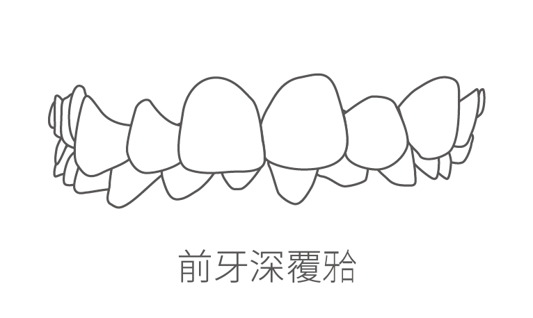 前牙深覆颌