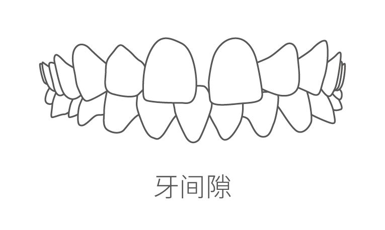 牙间隙